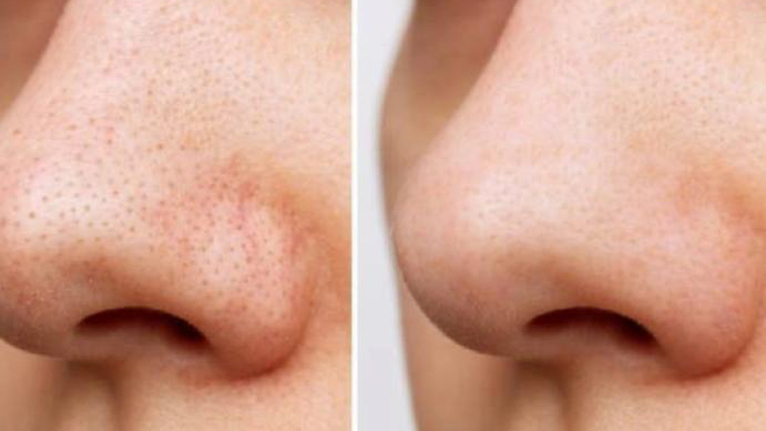 Rahasia Hidung Bebas Komedo yang Wajib Kamu Coba