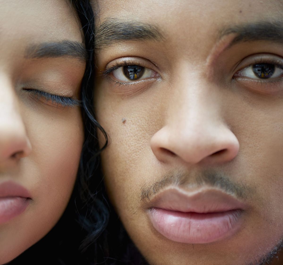 Pengalaman Injeksi Keloid di Wajah: Keloid Mengecil Hanya Dengan 2 Kali Treatment