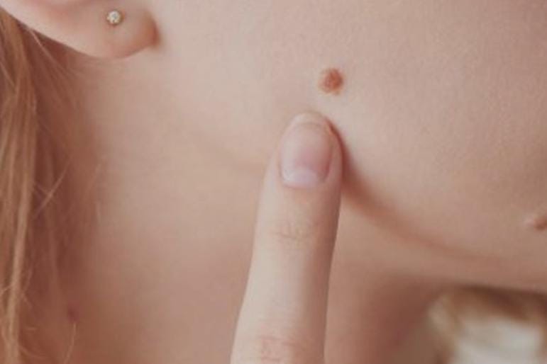 Cara Menghilangkan Kutil di Wajah Tanpa Bekas & Lebih Percaya Diri