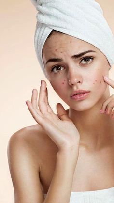 Pengaruh Gula terhadap Jerawat