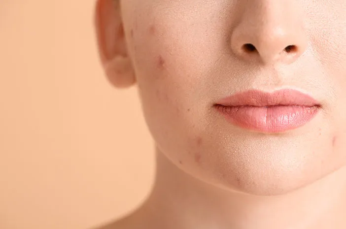 Perawatan Kulit Gagal Atasi Jerawat? Ini Penyebabnya!