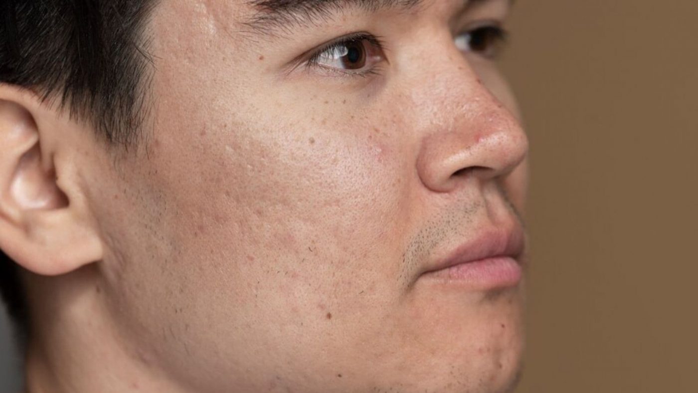 Treatment di Reglow Clinic: Solusi Tepat untuk Setiap Masalah Kulit Wajah