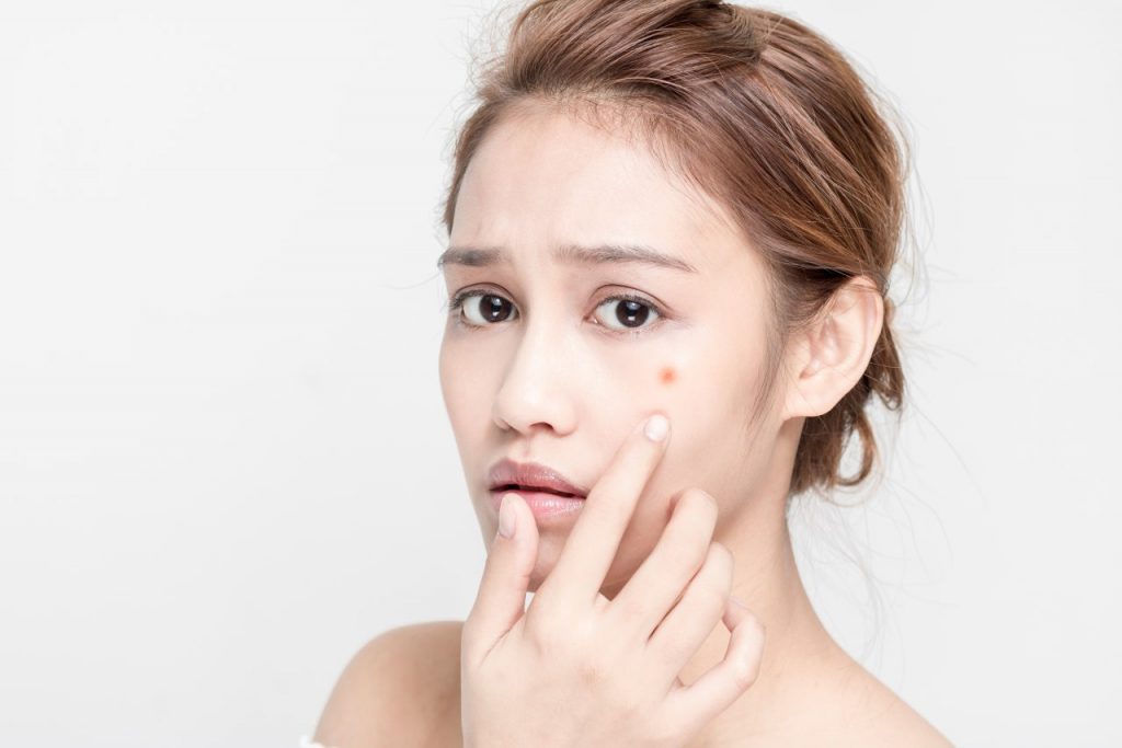 Hormon, Stres, Skincare? Ini Penyebab Jerawat di Usia 30-an