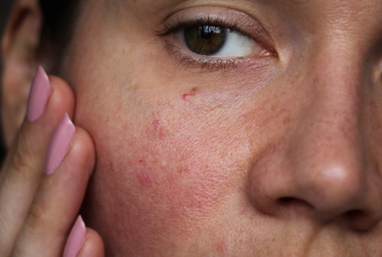 Kulit Terasa Kering dan Sensitif? Bisa Jadi Skin Barrier Rusak! Ini Solusinya