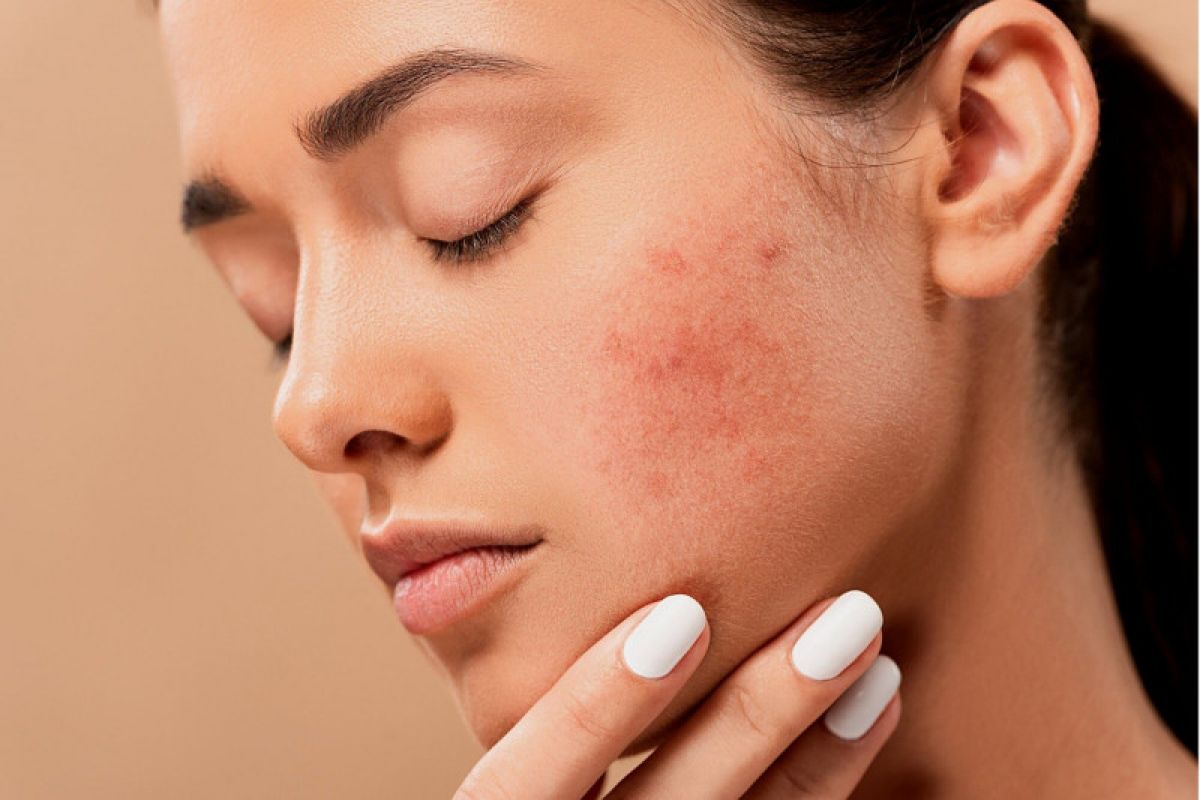 Hilangkan Bekas Jerawat dengan Cepat! Ini Pilihan Treatment Terbaiknya