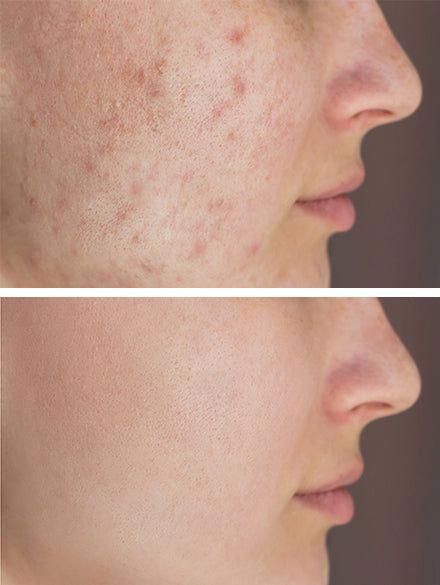 Pengalaman Dermapen Scar di Reglow Clinic: Bekas Jerawat Lebih Halus, Kulit Lebih Cerah