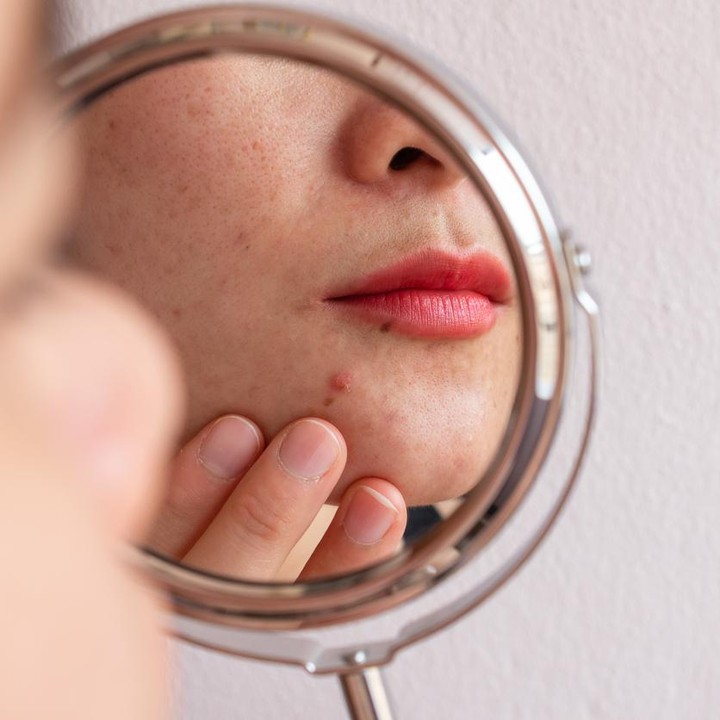 Jerawatan Setelah Pakai Skincare Baru? Ini 5 Penyebab Umumnya
